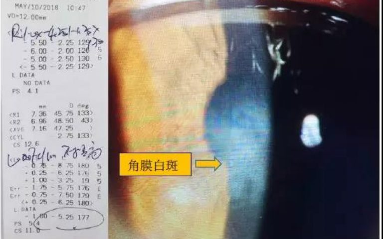 病毒性角膜炎引起角膜白斑与不规则角膜散光RGP视力矫正一例