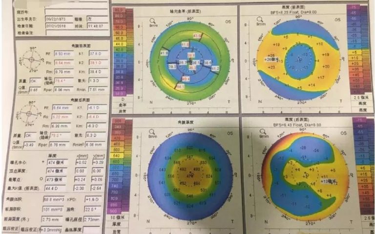 RGP在角膜屈光术后的应用