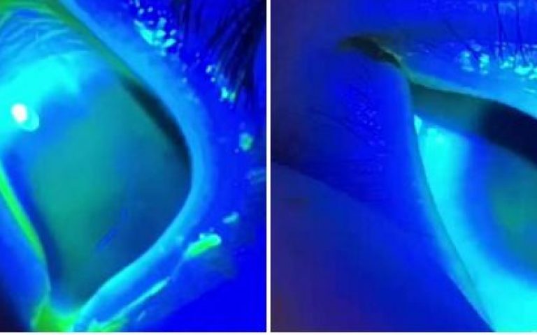 婴幼儿先天性小眼球合并白内障验配RGP隐形眼镜两例