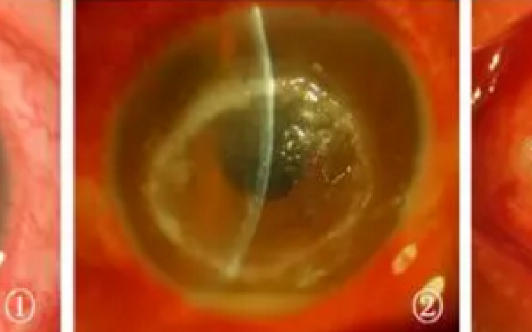 配戴OK镜和RGP,如何避免棘阿米巴感染?