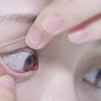 角膜塑形镜、RGP隐形眼镜发生偏位怎么处理