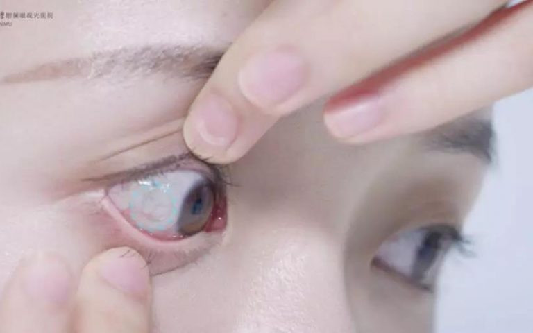 角膜塑形镜、RGP隐形眼镜发生偏位怎么处理